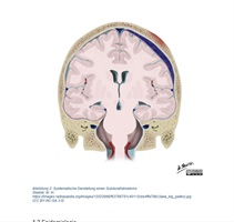 Hirnblutung/chronisches Subduralhämatom - die Neurochirurgie ist präpotent und die Neurologie naiv. Teil 3