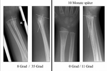 PR/Pressemitteilung: Unterarmfraktur: Spontankorrektur durch Knochenwachstum